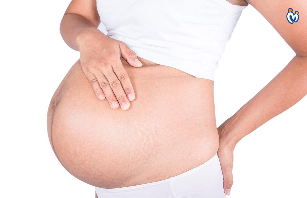 How to prevent stretch marks during pregnancy